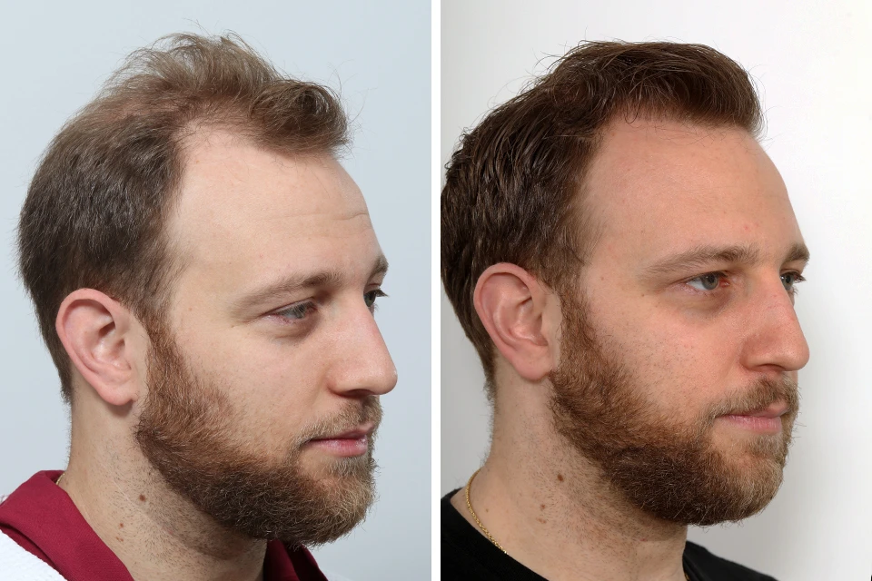 Male Hair Transplant