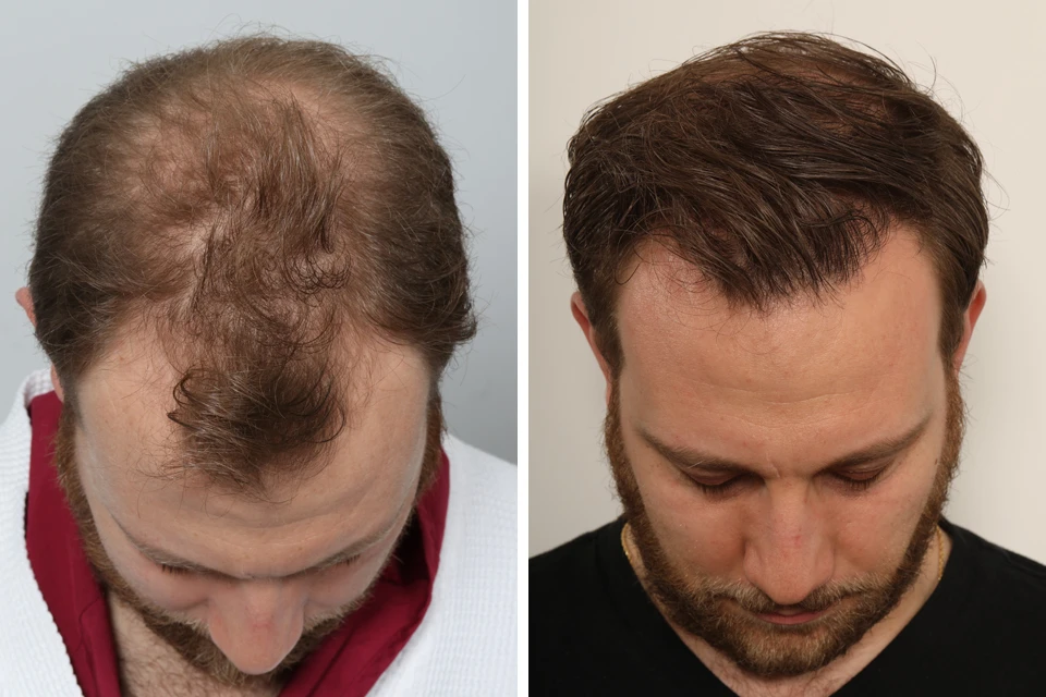 Male Hair Transplant