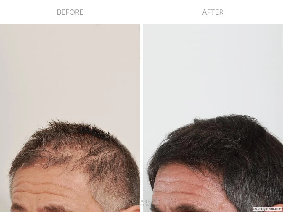 Male Hair Transplant