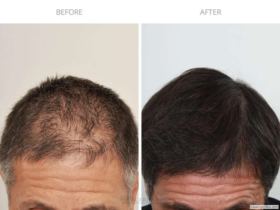 Male Hair Transplant