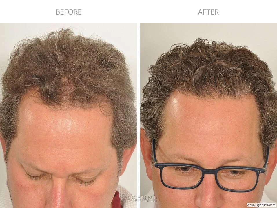 Male Hair Transplant