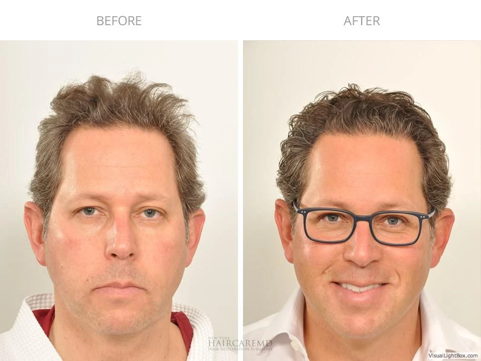 Male Hair Transplant