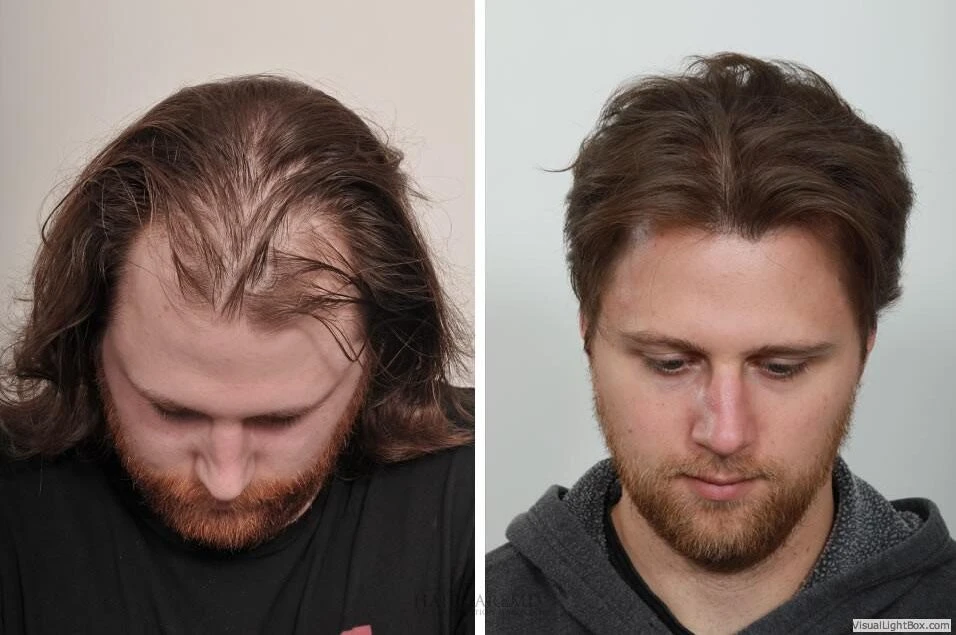 Male Hair Transplant