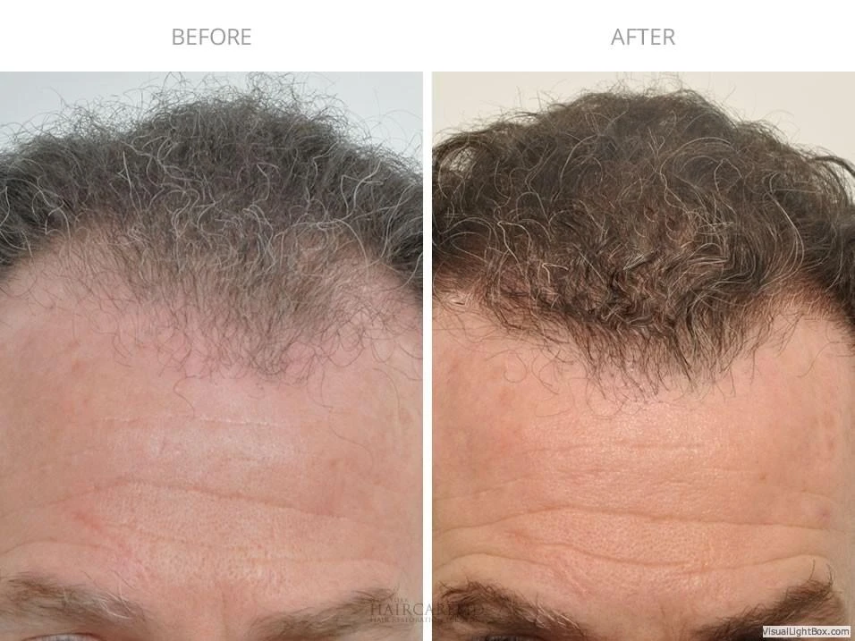 Male Hair Transplant