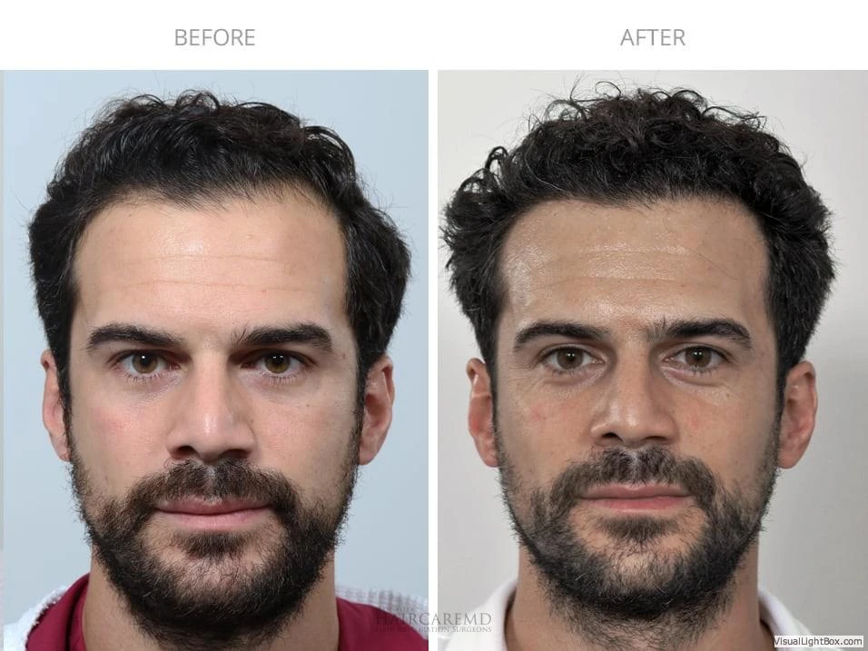 Male Hair Transplant