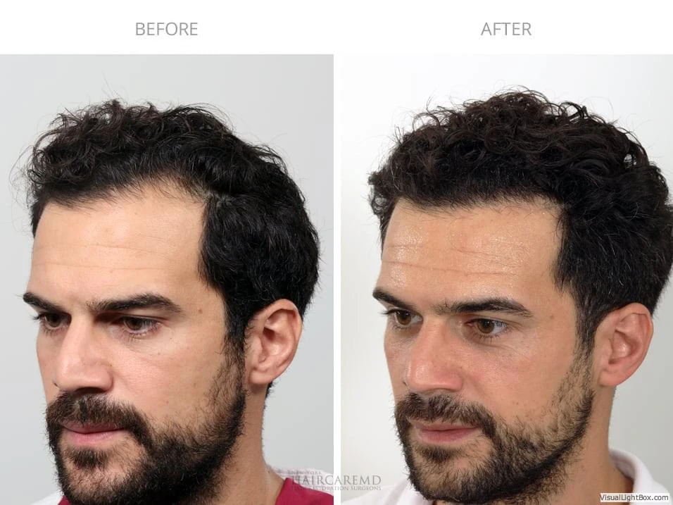 Male Hair Transplant