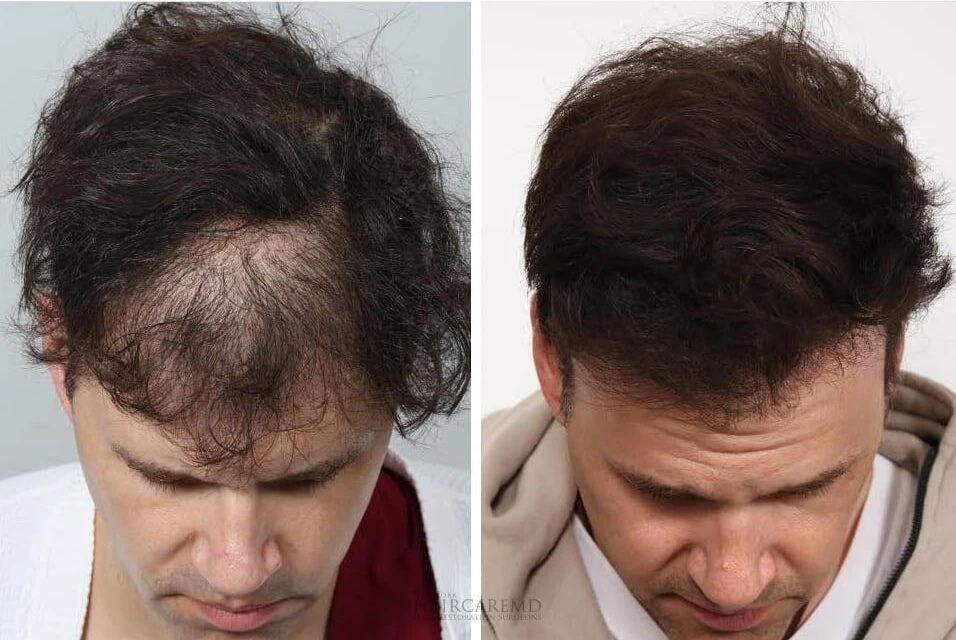 Male Hair Transplant