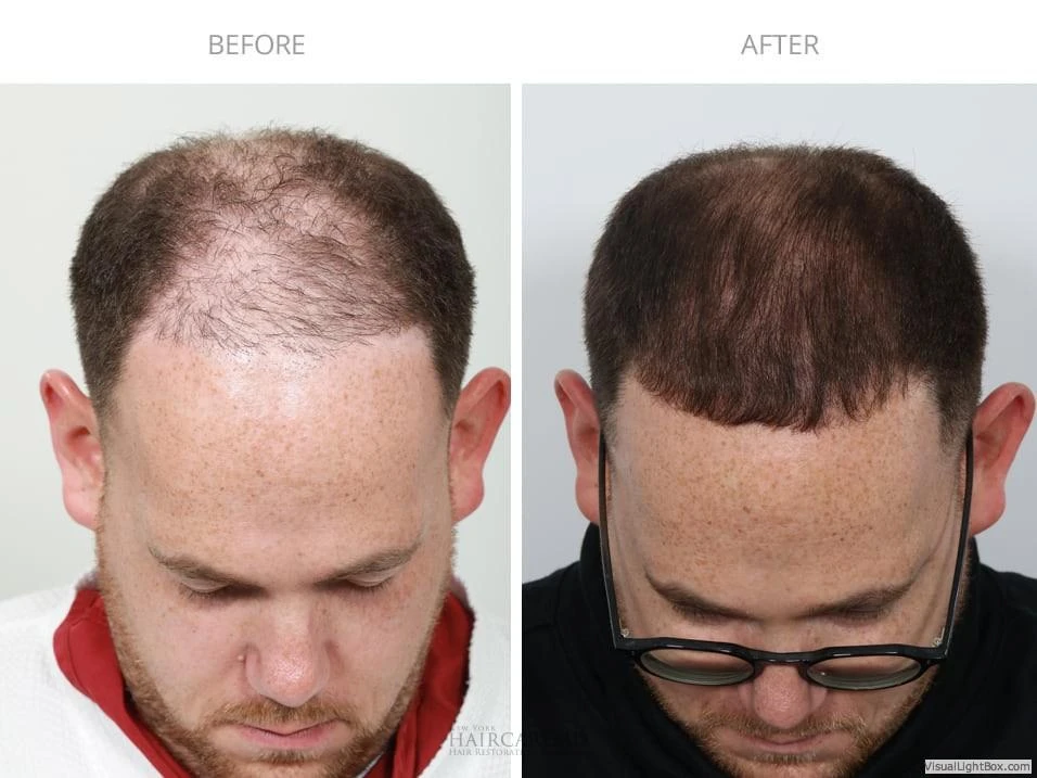 Male Hair Transplant