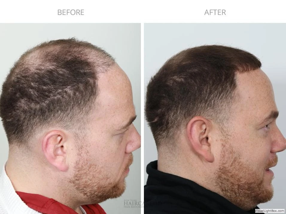 Male Hair Transplant