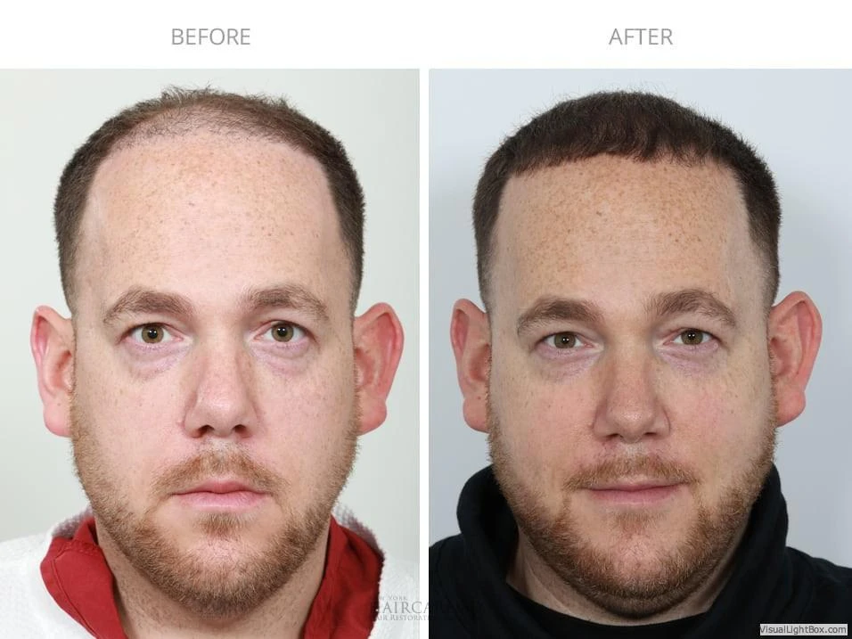 Male Hair Transplant