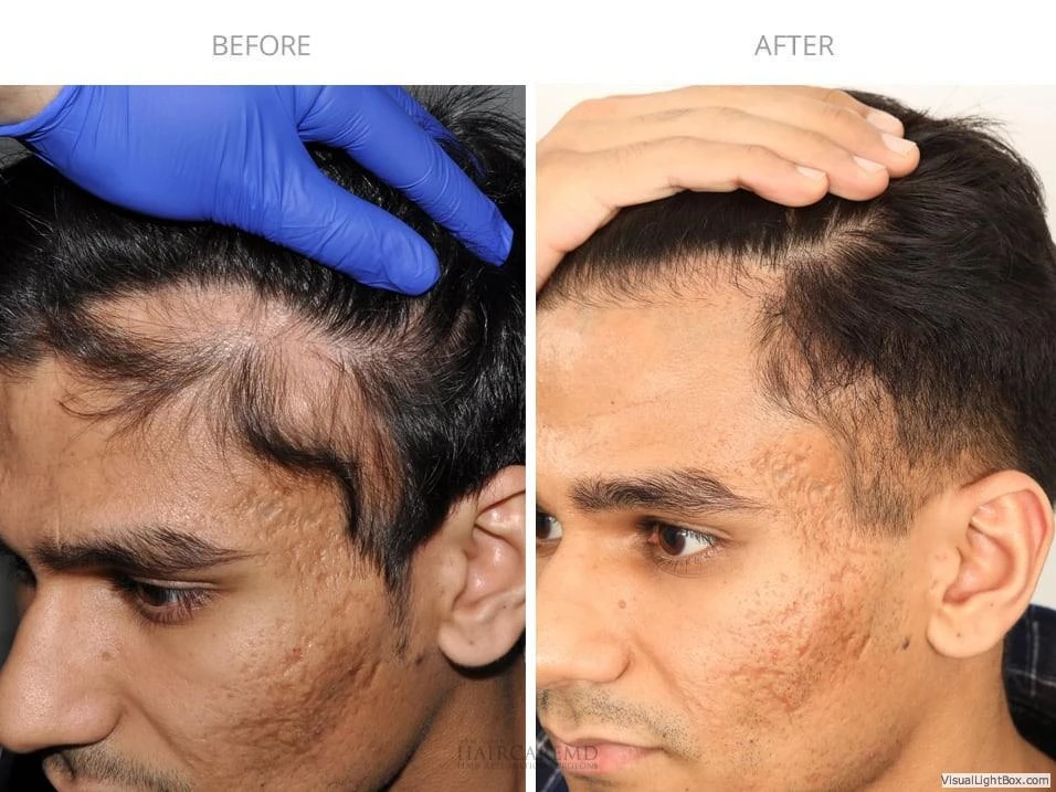 Male Hair Transplant