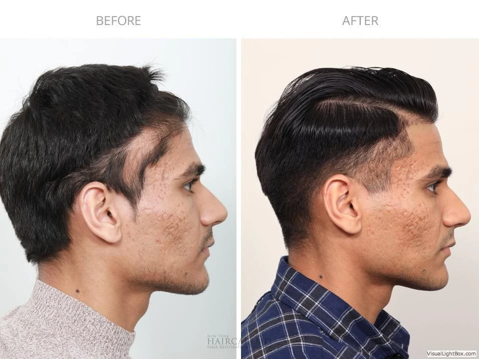 Male Hair Transplant