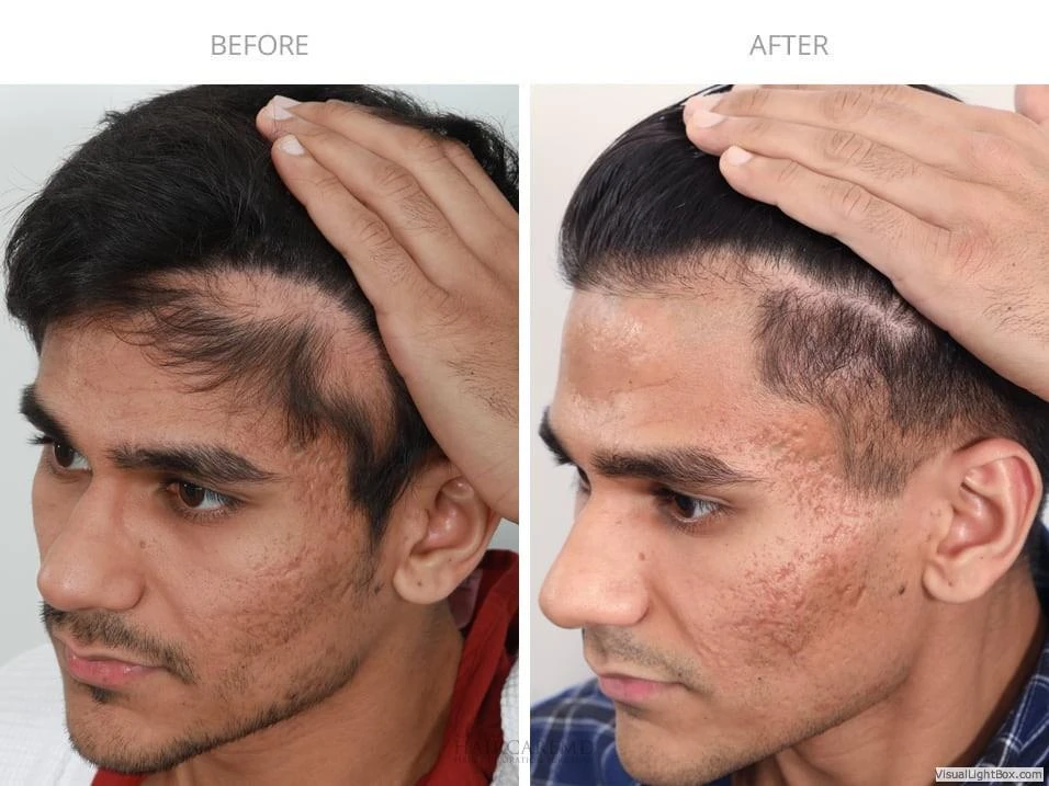 Male Hair Transplant