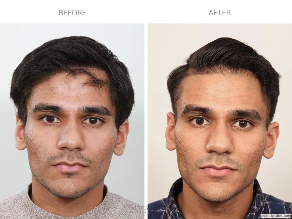 Male Hair Transplant