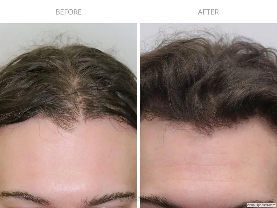 Female Hair Transplant