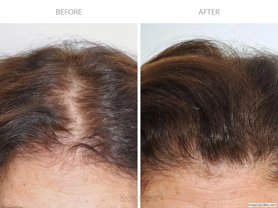 Female Hair Transplant