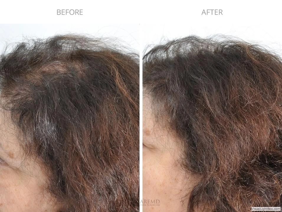 Female Hair Transplant