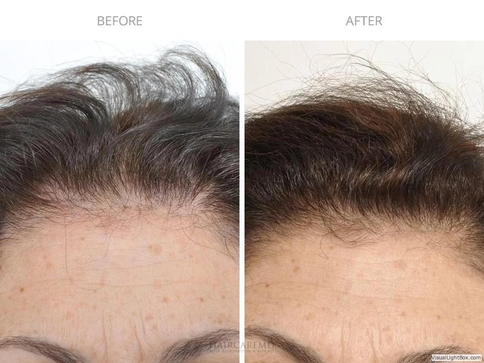 Female Hair Transplant