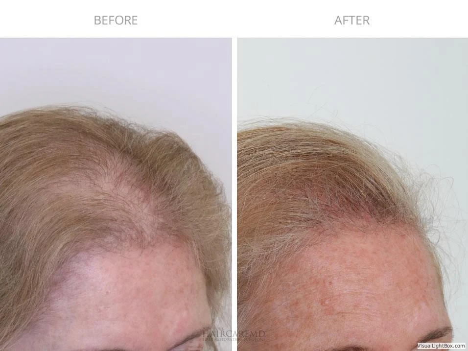 Female Hair Transplant