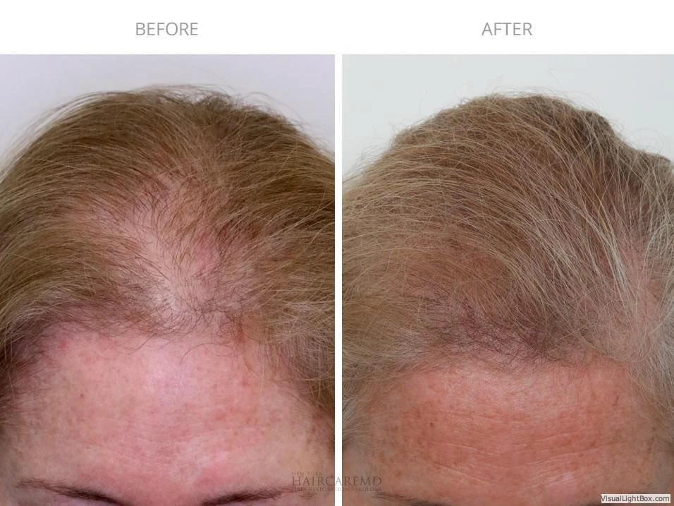 Female Hair Transplant