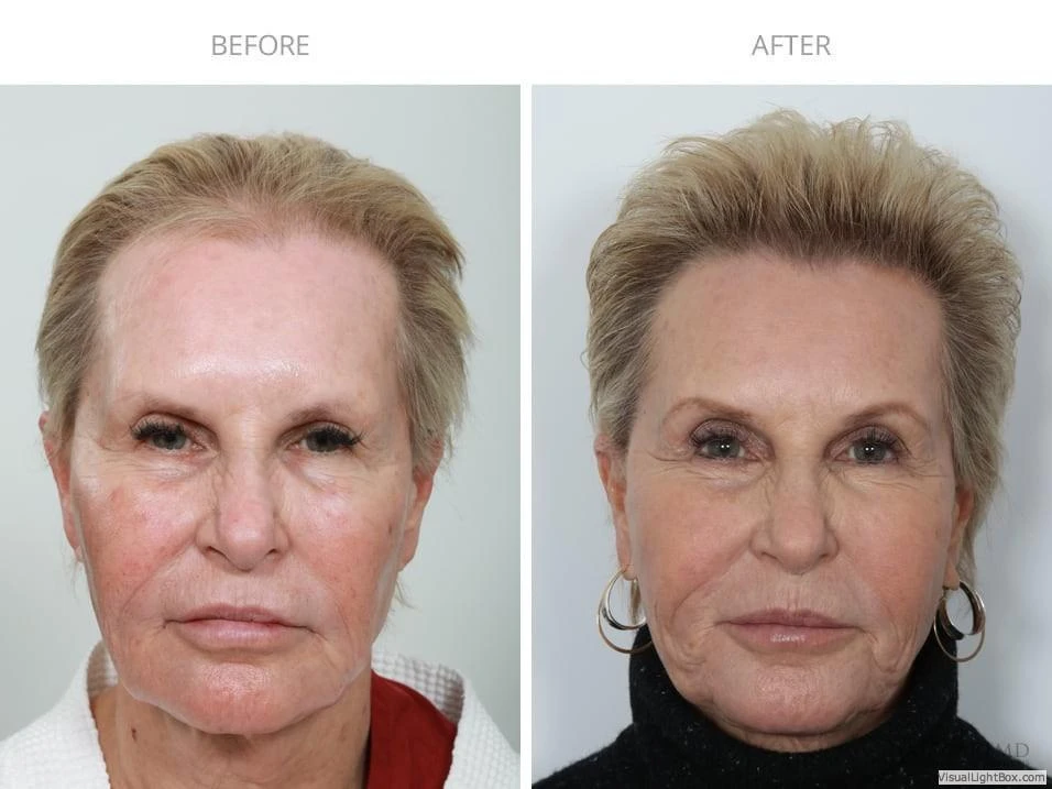 Female Hair Transplant