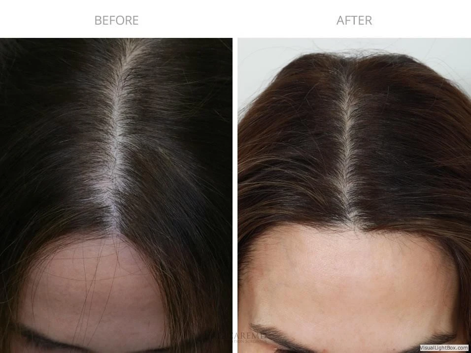 Female Hair Transplant