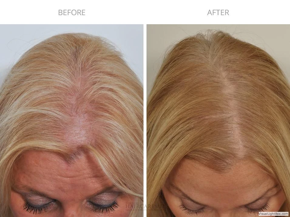 Female Hair Transplant