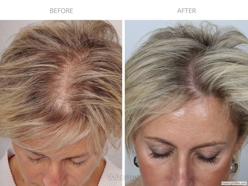 Female Hair Transplant