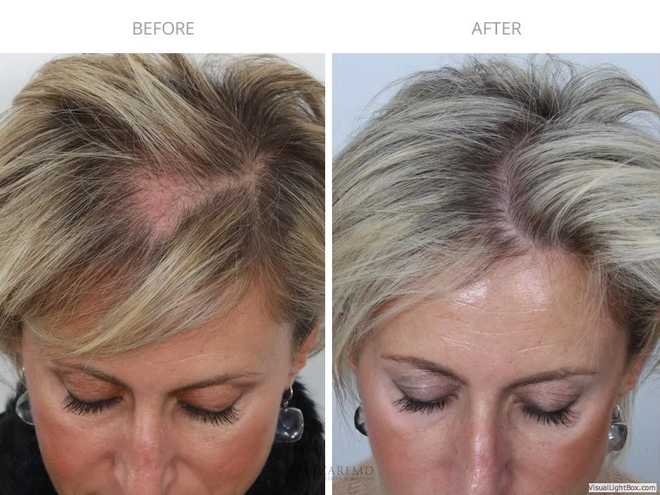 Female Hair Transplant