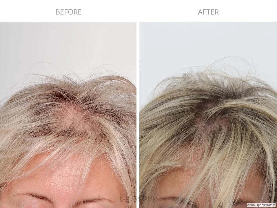 Female Hair Transplant