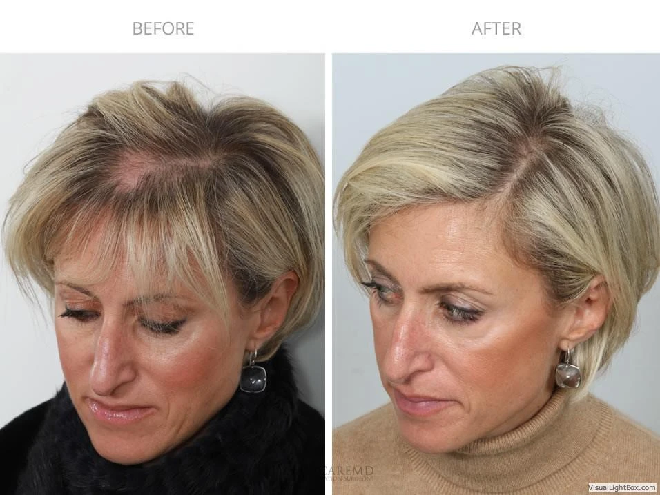 Female Hair Transplant