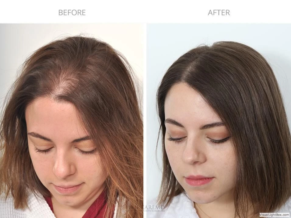 Female Hair Transplant