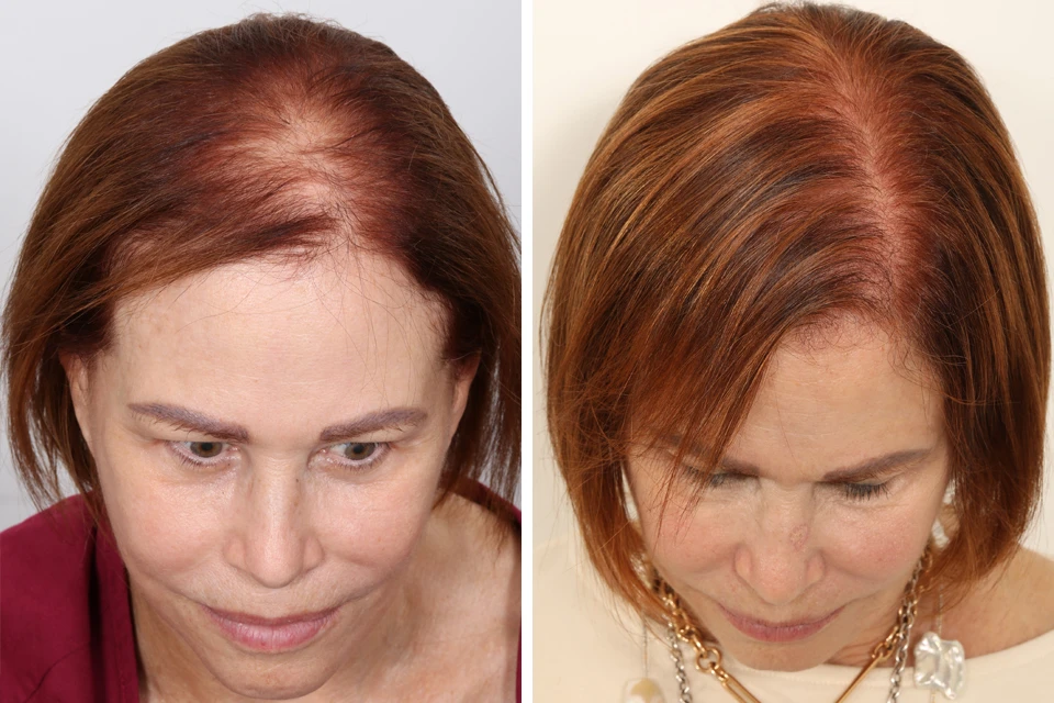 Female Hair Transplant