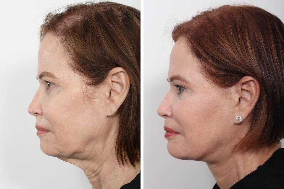 Female Hair Transplant