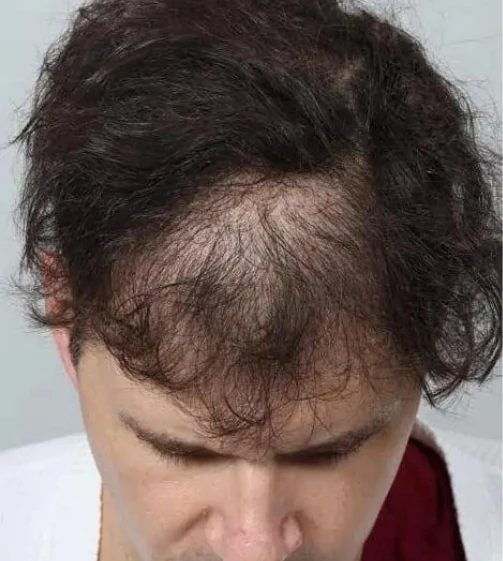 Actual male hair transplant patient before the procedure