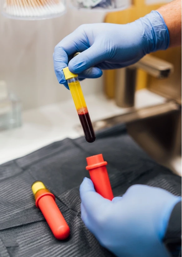 Photo of tubes of platelet-rich-plasma, or PRP - Hair Treatment in NYC
