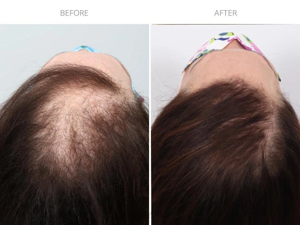 Female Hair Transplant