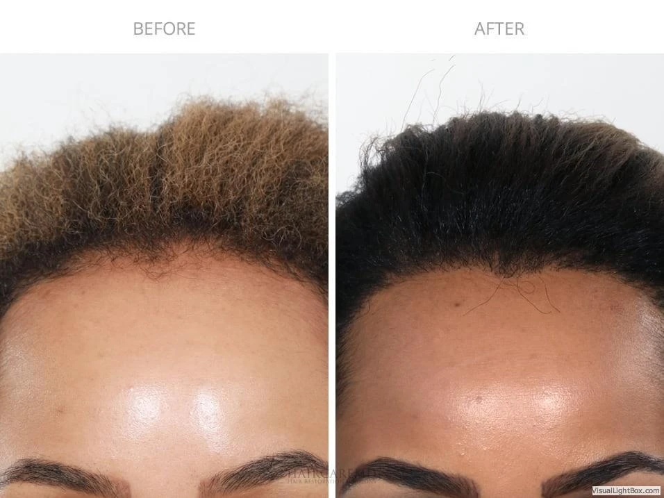 Female Hair Transplant