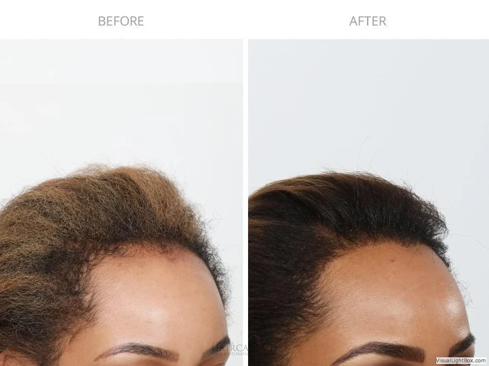 Female Hair Transplant
