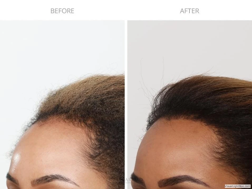 Female Hair Transplant