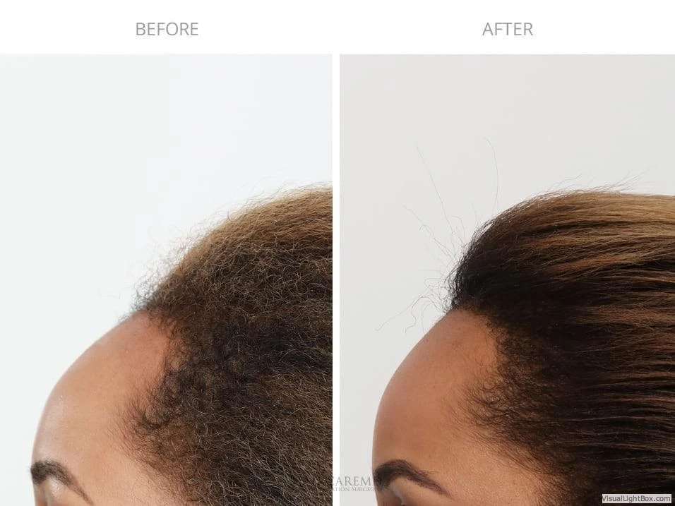 Female Hair Transplant