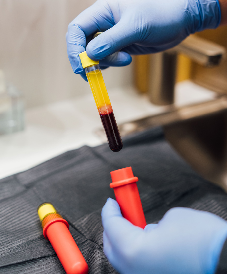 Photo of platelet-rich-plasma or PRP in tube