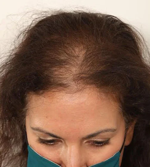 Real patient before Female Hair Transplant Procedure