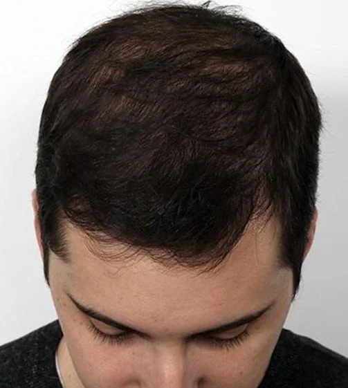 Real patient after Male Hair Transplant procedure