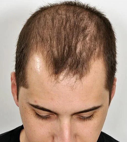 Real patient before Male Hair Transplant procedure