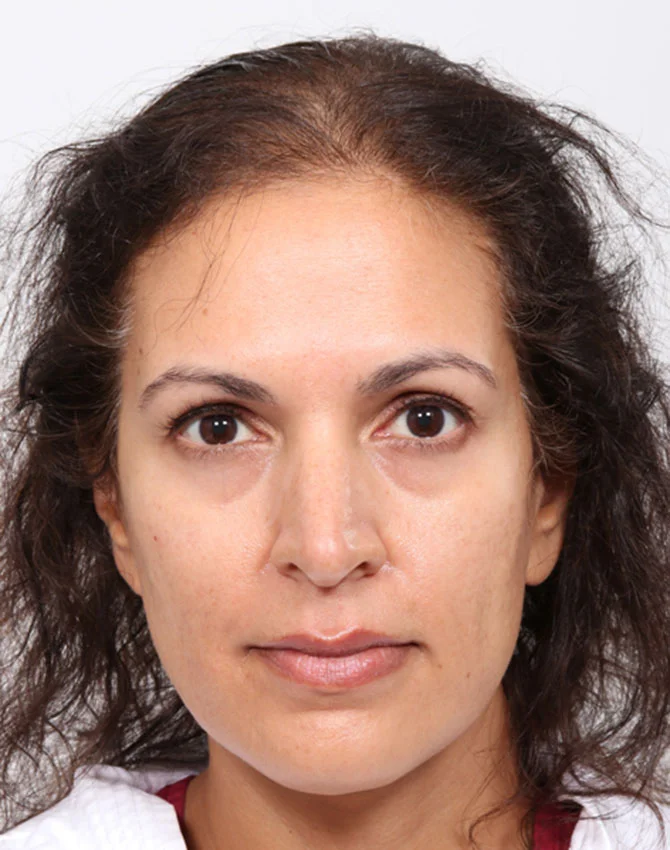 Real female hair transplant patient before procedure photo