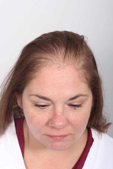 Female Hair Transplant