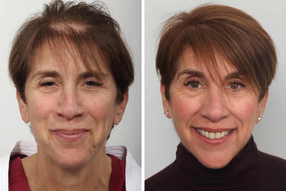 Female Hair Transplant