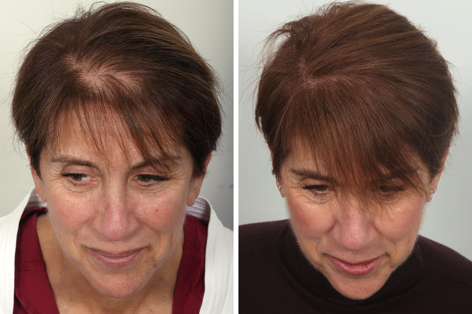Female Hair Transplant