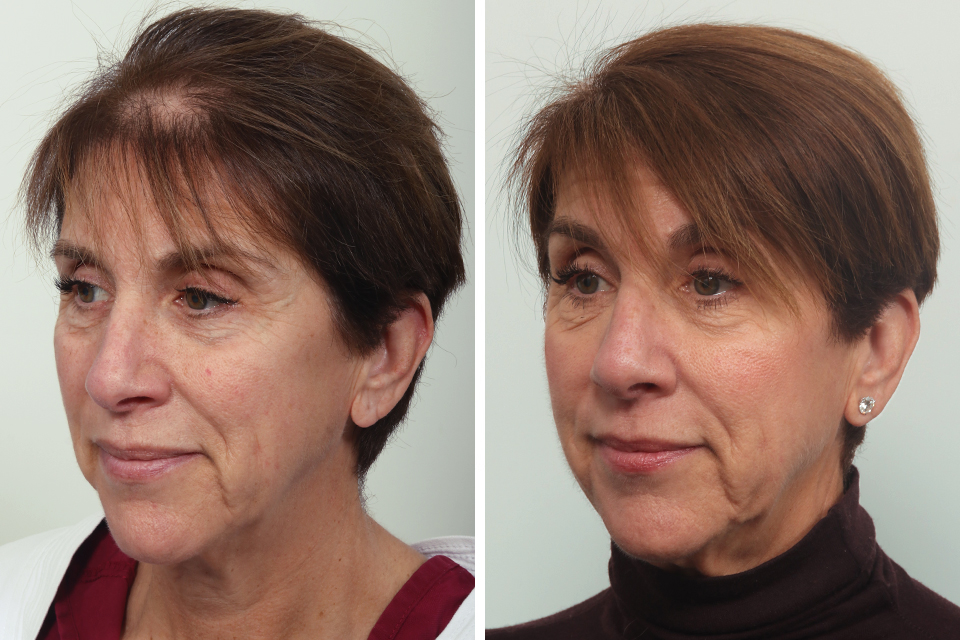 Female Hair Transplant